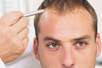 Was ist Haartransplantation