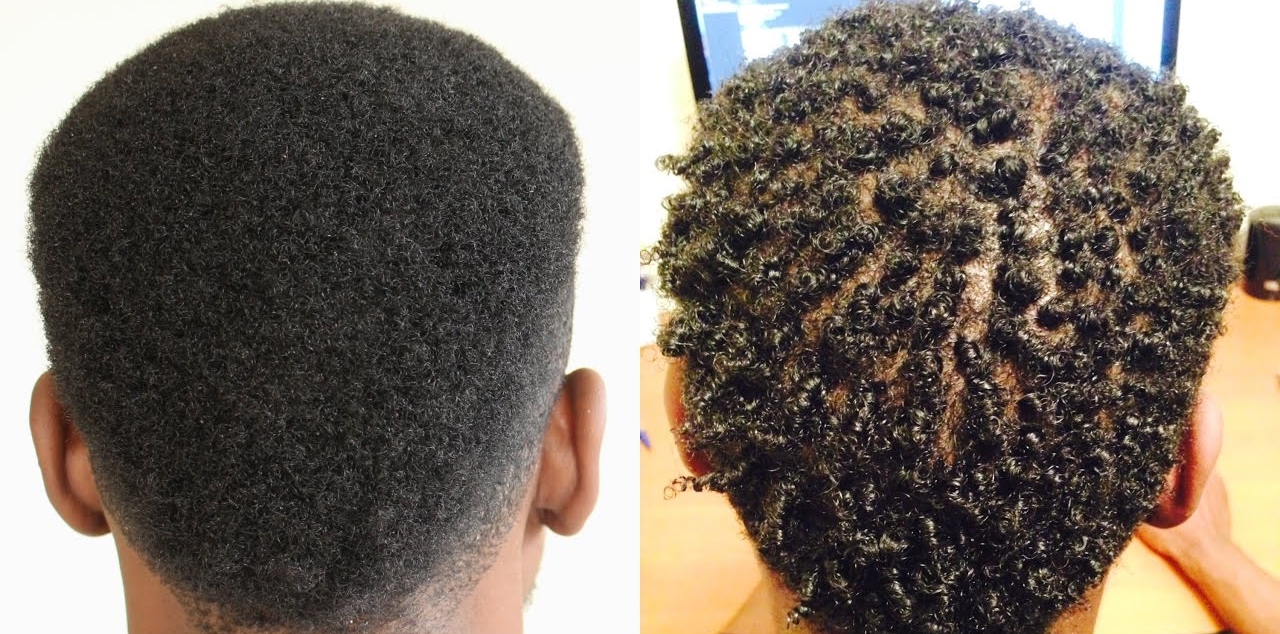 AFRO-HAARTRANSPLANTATION